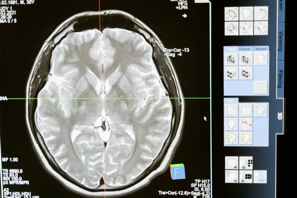 Brain Tumor Pathology and Classification