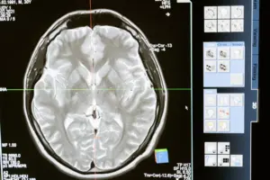 brain tumor pathology