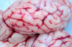 hypoxic ischemic encephalopathy neuropathology