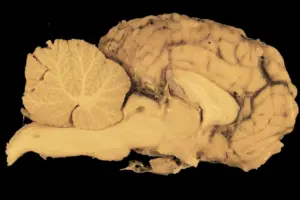 brain herniation types