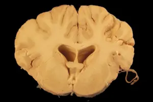 astrocytes in neuropathology