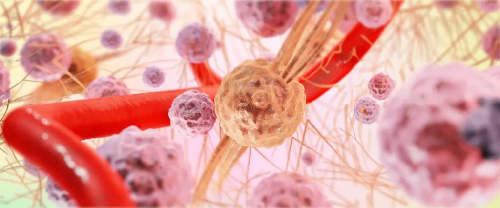 Oligodendroglioma Pathology