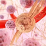 Oligodendroglioma Pathology