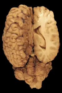 ependymoma histology